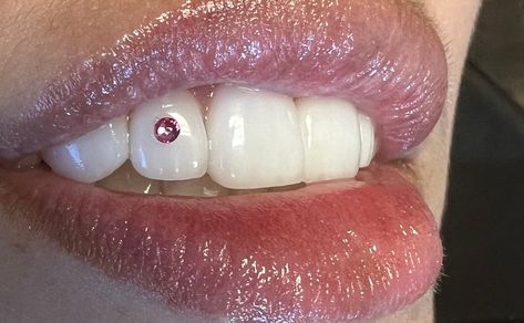Tooth Gems