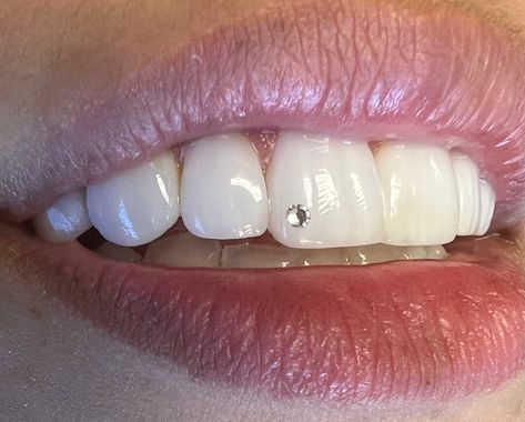 Tooth Gems